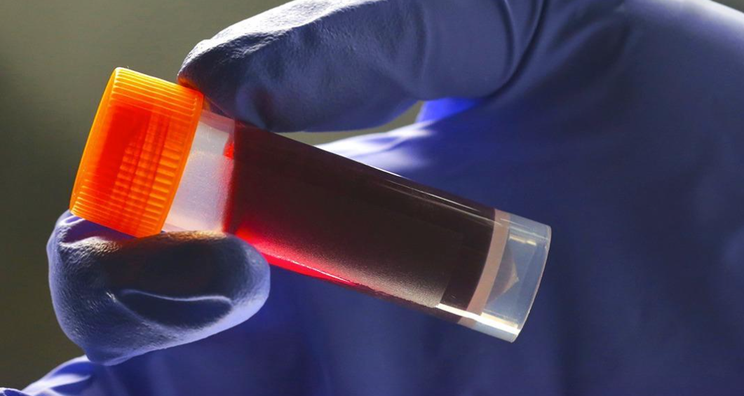 Researchers show which blood group has the lowest cancer risk