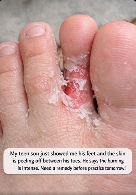 My teen son just showed me his feet and the skin is peeling off between his toes. He says the burning is intense. Need a remedy before practice tomorrow!