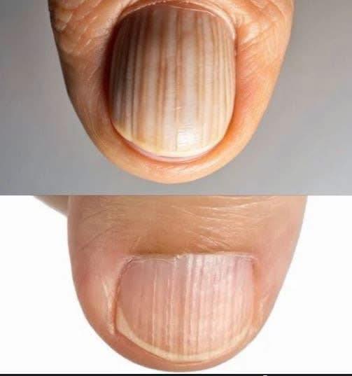 Why You Should Never Ignore These Mysterious Lines On Your Nails Because They Might Be Your Bodys Final Warning About A Serious Hidden Health Condition