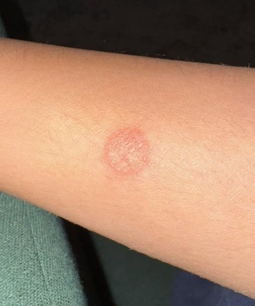5 Simple Home Habits to Prevent Ringworm and Keep Your Skin Healthy