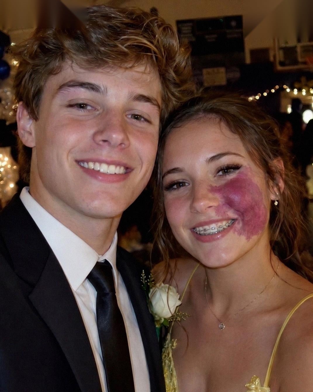 Only One Boy Asked Me to Prom Because No One Else Wanted to Due to the Birthmark on My Face – Everyone Laughed Until an Officer Walked Into the Hall