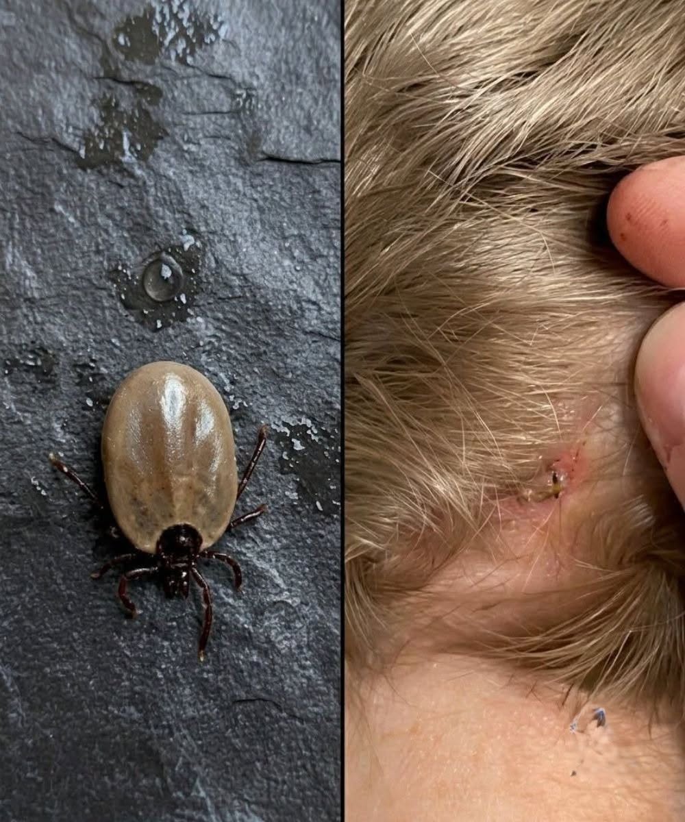 You Are Likely Ignoring The Deadly Warning Signs Of A Tick Bite That Could Ruin Your Life