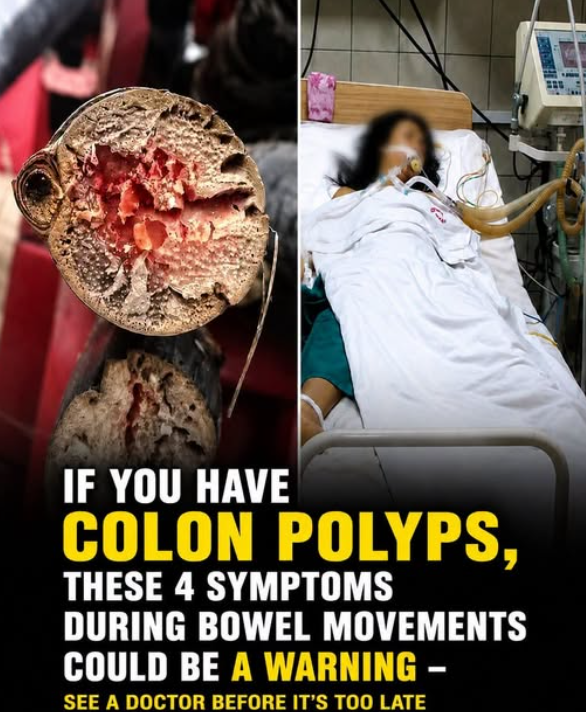 Stop Ignoring Your Bathroom Habits! The Terrifying 4 Symptoms That Prove You Might Have Silent Colon Polyps Before It’s Too Late!