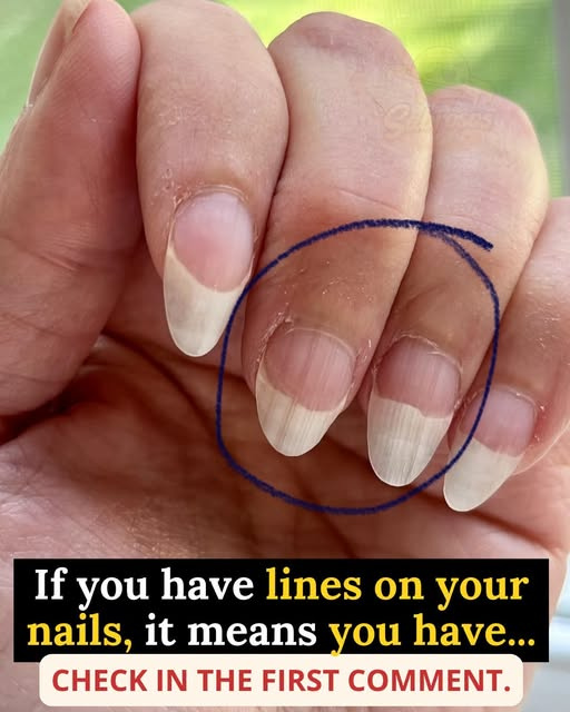 What do white lines on the nails mean?