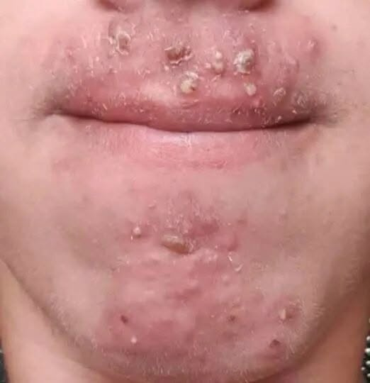 Been dating this woman I met at Walmart and after finally getting some I woke up with these on my face what is this?